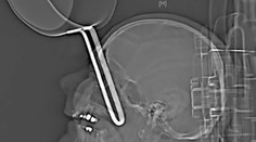 Lekári niečo podobné ešte nevideli: Opitý Nemec si vrazil panvicu do lebky