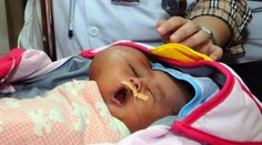 V Indonézii sa narodil chlapec s veľkým tumorom. Jeho tvár pripomína srdce