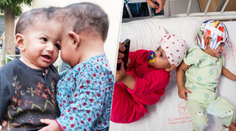 Dvojičky sa narodili so spojenými hlavičkami. Po úspešnom zákroku ich čaká plnohodnotný život