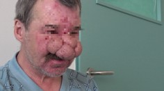 Kvôli nosu si zažil peklo. Teraz urobil radikálne rozhodnutie a my sme boli pri tom