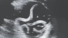 Nepríjemný nález ultrazvukom: Mužovi žili v žalúdku červy