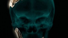 Objavili doteraz neznámy druh predka človeka. Bol podobný neandertálcom