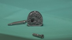 Unikátna operácia: Roman (50) dostal medzistavcovú platničku z 3D tlačiarne