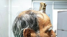 Vzácny prípad šokoval aj lekárov: Mužovi narástol na hlave "diabolský roh"