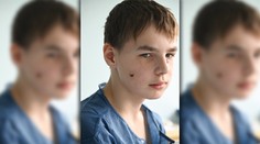 Je dieťa a už vie, čo je to vojnové zranenie. Slovenskí lekári zachránili tvár chlapcovi, ktorý prežil bombardovanie Charkova
