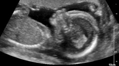 Je to chlapec! Dojatá hviezda Harryho Pottera zverejnila fotku z ultrazvuku