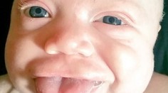 Dievčatku narástol veľký jazyk. Takto vyzerá teraz s úsmevom na perách