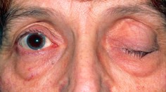 Trápia vás ovisnuté očné viečka? Plastický chirurg nám porozprával, čo sa s tým dá robiť