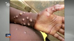 Svetová zdravotnícka organizácia vyhlásila pre opičie kiahne medzinárodný stav ohrozenia