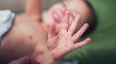 Spojené štáty evidujú najviac prípadov osýpok od roku 1994