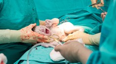 Je cisársky rez nebezpečný trend? Odborník to povedal natvrdo