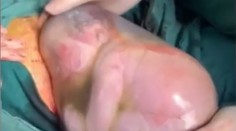 Chlapček sa narodil s "čepcom šťasteny". Dýchať začal až po dvoch minútach