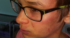 Ďalší dobitý chlapec. Matka tvrdí, že na jej syna zaútočil riaditeľ školy