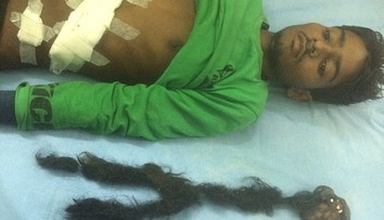 Chlapec chudol a zvracal. Lekári v jeho tele našli parazitické dvojča