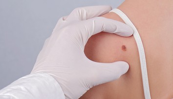 Trápia vás znamienka? Teraz je ideálny čas na ich vyšetrenie a odstránenie