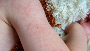 Osýpky nie sú banálne ochorenie. Pre jednu skupinu pacientov môže byť fatálne