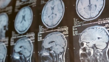 Vedci tvrdia, že vedia, prečo ľudia so schizofréniou „počujú hlasy“