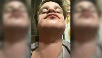 Žena chcela priateľovi natrieť bradu farbou na vlasy. Bizarný nápad skončil popáleninami