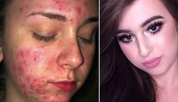 Tínedžerka trpela hrozným akné. Takto ho dokázala maskovať