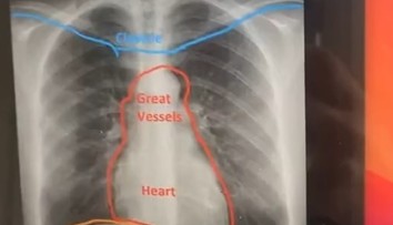 Tínedžerku (19) dlhšie trápil kašeľ. Následné röntgenové vyšetrenie odhalilo nečakanú anomáliu