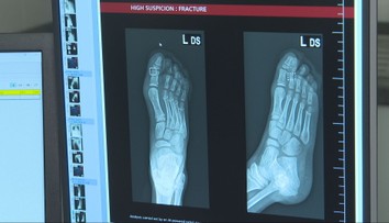 Košickí lekári na urgente využívajú umelú inteligenciu. Dokáže zbadať aj tie najmenšie zlomeniny