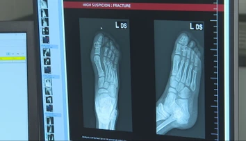 Košickí lekári na urgente využívajú umelú inteligenciu. Dokáže zbadať aj tie najmenšie zlomeniny