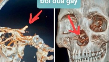 Muž žil mesiace s bolesťami hlavy. Keď si lekári pozreli CT snímku, neveriacky si pretierali oči