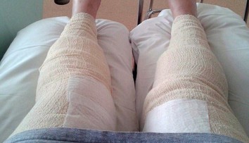 Šokujúci prípad. Oholila sa v oblasti bikín a takmer prišla o nohy