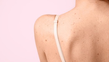 Ako chrániť znamienka pred slnkom? Tu je niekoľko užitočných rád