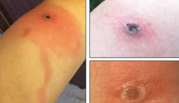 Nové vírusové ochorenie má prvú obeť. Všetko sa zrejme začalo škrabancom od mačky