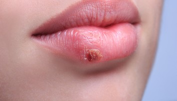 Oslabená imunita a stres vedú k tvorbe oparov. Šesť tipov na ich vyliečenie