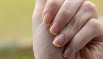 Biele škvrny či ryhy na nechtoch. Môžu poukazovať na nedostatok vitamínov, ale aj vážne ochorenia