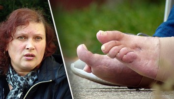 Ani sedem rokov po operácii haluxov sa Márii stav nezlepšil. Odporúčajú jej amputáciu