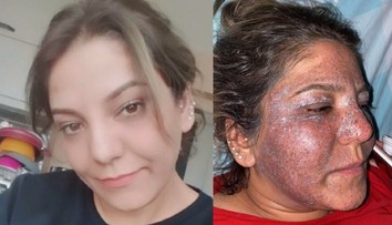 Túžila po vyhladení vrások, po zvláštnom zákroku však skončila s hnisom a opuchmi na tvári