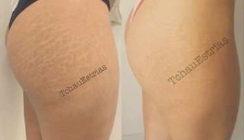 Takto by vám asi nenapadlo zbaviť sa strií. Nová metóda však naozaj funguje