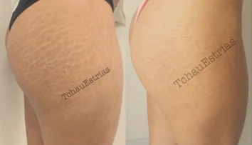 Takto by vám asi nenapadlo zbaviť sa strií. Nová metóda však naozaj funguje