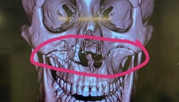 VIDEO: Ragbista utrpel hororové zranenie. Po zrážke hlavami si odtrhol celú čeľusť