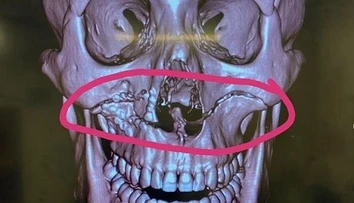VIDEO: Ragbista utrpel hororové zranenie. Po zrážke hlavami si odtrhol celú čeľusť