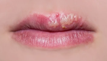 Z lekární i nemocníc sťahujú liek na herpes