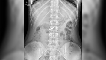 Výzva na sociálnej sieti dostala deti do nemocnice: Prehltli magnety, teraz bojujú o život