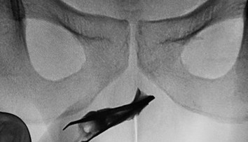 Mladík (22) mal štyri roky v penise netypický predmet. Necítil vraj žiadnu bolesť