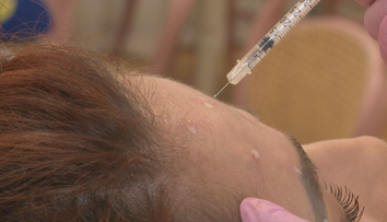 Botox je bežný už aj v dvadsiatke. Mladí sa čoraz viac obávajú vrások