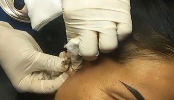 VIDEO: Lekár neveril vlastným očiam. Nenápadná vyrážka takmer poškodila žene ucho