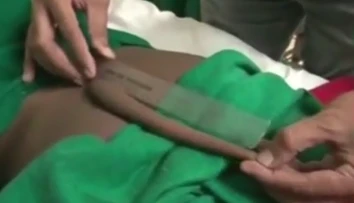 Indický tínedžer žil s 18-centimetrovým chvostom, teraz ho museli odrezať