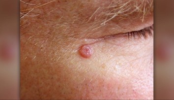 Máte malé škvrny na tvári? Nezanedbávajte vyšetrenie, doktor varuje pred stratou oka