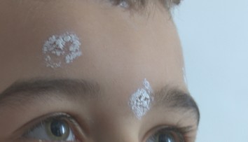 Prežívame vlnu ovčích kiahní. Pýtali sme sa lekárky, či je nutné očkovanie