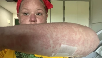 Ženu bodol na dovolenke nebezpečný hmyz. V reakcii s antibiotikami jej opadávali koža, vlasy aj nechty