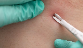 Na Slovensku tento rok evidujú vyše 180 prípadov kliešťovej encefalitídy. Riziko nepodceňujte ani na jeseň