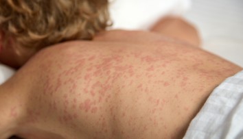 Na východe Slovenska potvrdili tri prípady osýpok