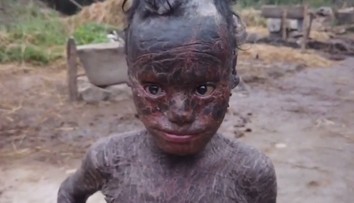 VIDEO: Chlapec (10) trpí vzácnou mutáciou. Jeho koža rýchlo schne a zhadzuje sa